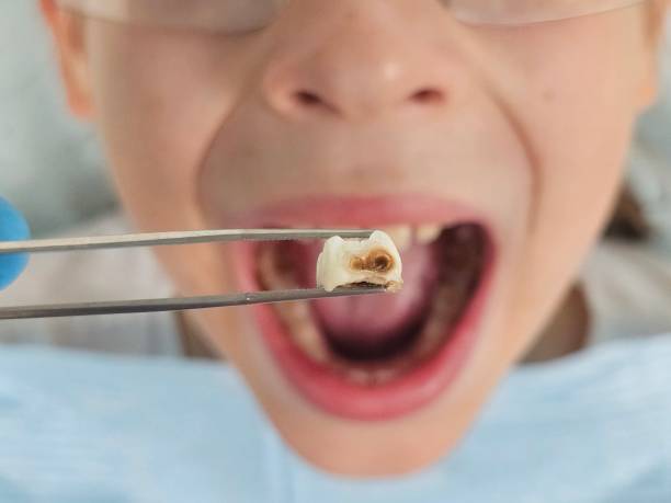 Best Chipped Tooth Repair Near Me  in Bixby, OK